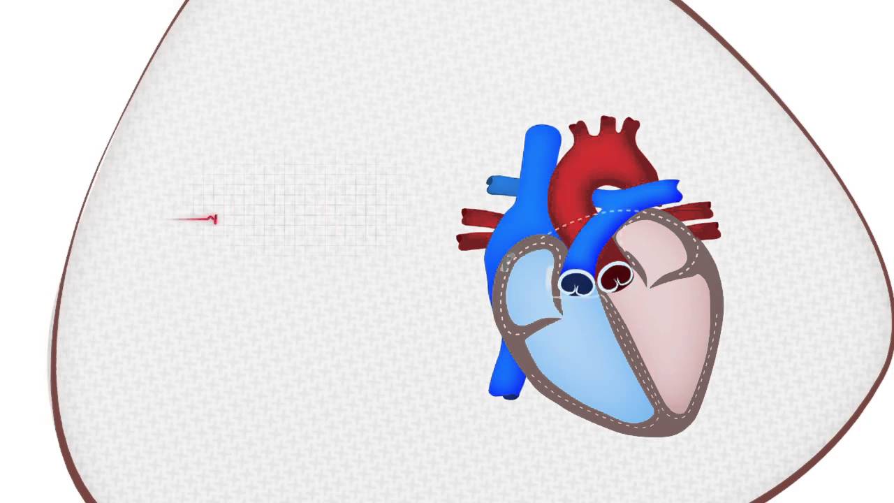Sudden Cardiac Arrest (SCA) explained