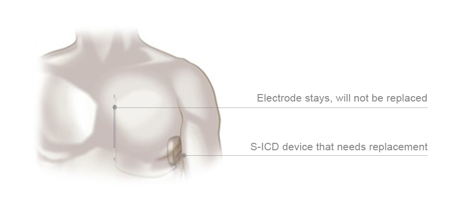 s-icd device replacement needed