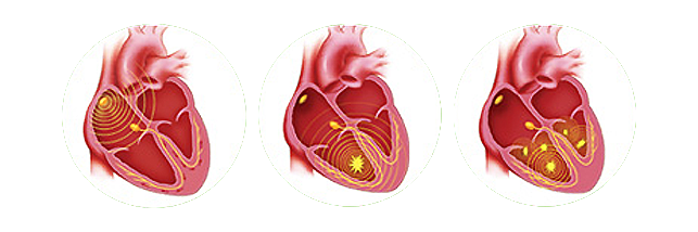 Sudden Cardiac Arrest Is Not the Same as a Heart Attack